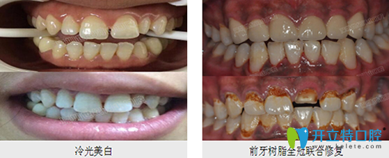 深圳世纪河山口腔牙齿冷光美白 前牙树脂全冠联合修复案例