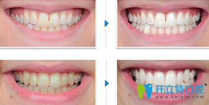 厦门登特口腔牙齿美白前后效果对比图