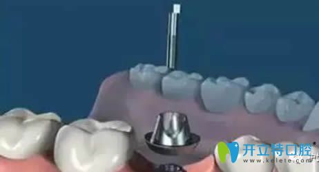 5,安装修复基台: 等待软组织成形后,种植牙医生取下愈合帽,安装修复