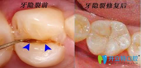 科普牙隐裂是什么症状以及牙齿隐裂怎么治疗和护理