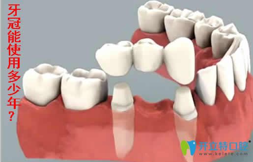 戴牙冠会出现什么后遗症介绍牙冠的种类及价格