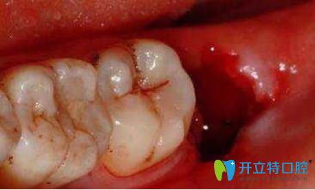 怎么判断是干槽症那就请看拔牙后干槽症早期症状和图片吧