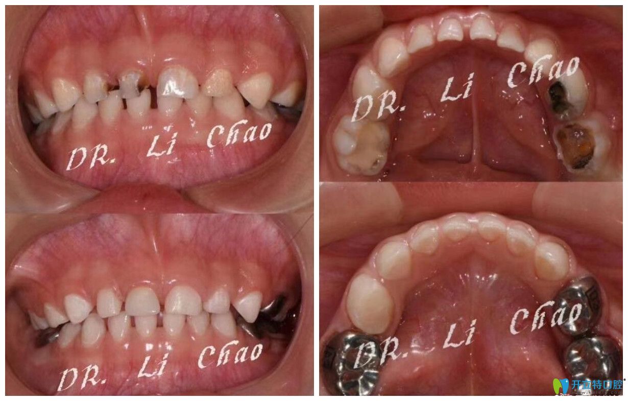 北京三叶儿童口腔睡眠舒适治疗修复牙齿案例效果对比照片