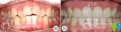 不拔牙,隐形矫正;牙齿情况:上牙错乱不齐;1,隐形牙齿矫正案例:30岁,高