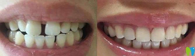 牙齿稀疏树脂贴面修复前后对比图