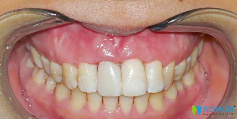 牙龈萎缩修复再生手术牙齿黑三角的救星