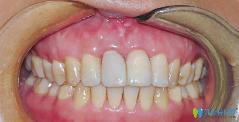牙龈萎缩修复再生手术是恢复牙齿黑三角的救星