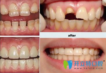 牙齿美容修复效果前后对比图