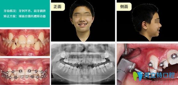 深圳正夫口腔固定矫正价格8000元隐形矫正15000元起