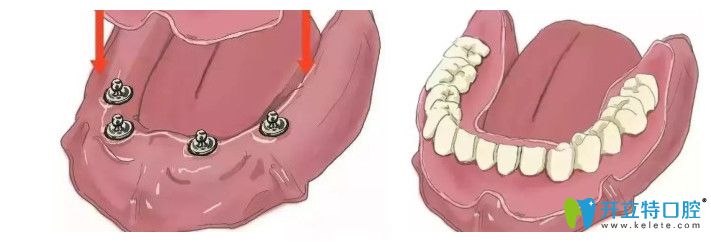 揭开天津中诺口腔种植牙全过程,含单颗/多颗和全口义齿种植
