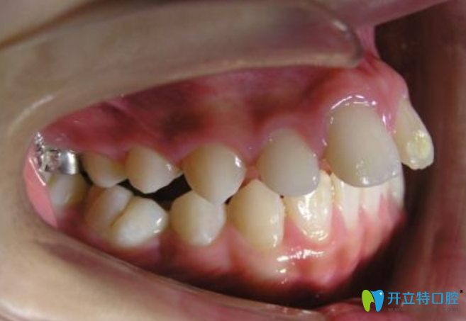 科普:深覆合骨性和牙性的区别并附骨性和牙性的矫正方法