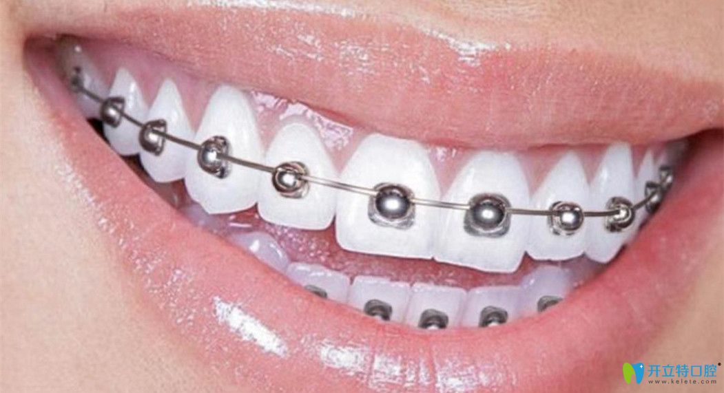 牙齿正畸中传统自锁牙套和球面托槽自锁矫正的价格及区别