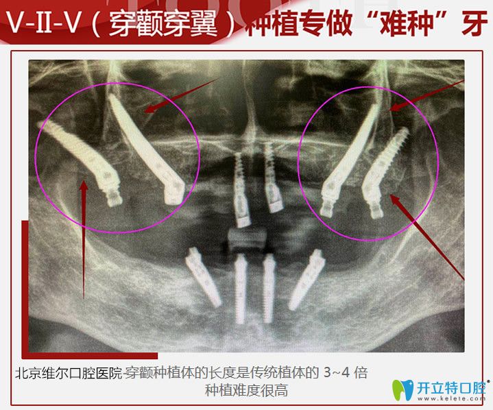 北京维尔口腔穿颧穿翼种植牙技术