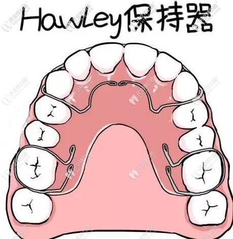 hawley哈雷保持器的优劣