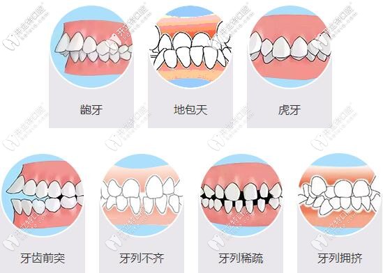 牙齿畸形对我们的影响很大