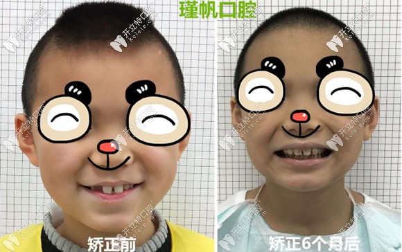 7岁小孩换牙后成了龅牙,戴活动矫正器半年后终于初见成效