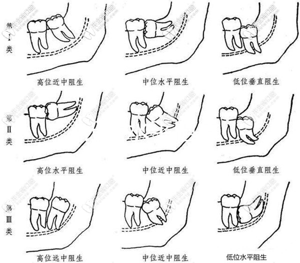 低位阻生智齿一定要拔吗和高位的那点区别侬要注意哟