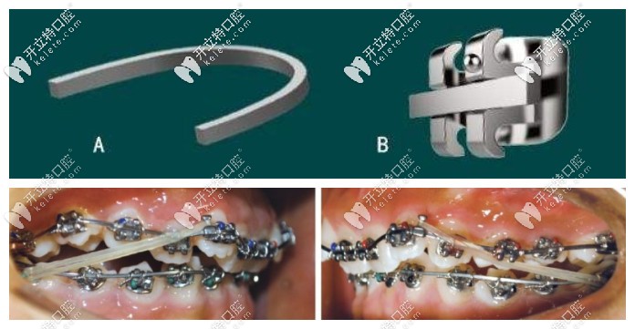 牙齿深覆合矫正用带状弓矫治器和直丝弓矫正各有啥优缺点