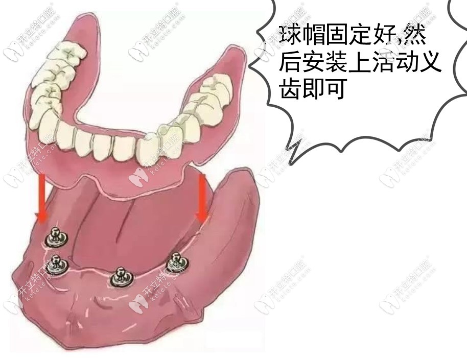 上海连锁口腔医院半口种植牙17800起,有5.1老爸种牙案例为证