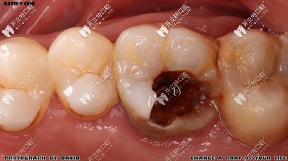 1,起初牙齿状况前因后果——顾客后磨牙龋坏,反复疼痛多日,在根管