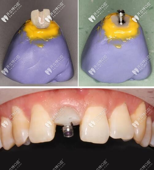 门牙外伤瑞士iti钛亲水4110mmbl即刻种植牙修复案例超全解析