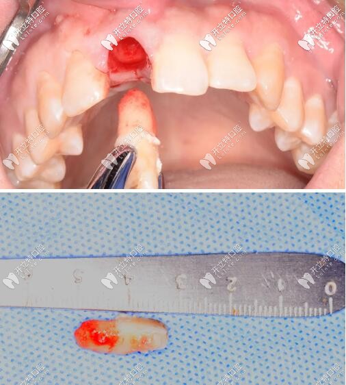 门牙外伤瑞士iti钛亲水4110mmbl即刻种植牙修复案例超全解析