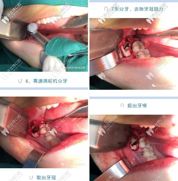 武汉拔牙案例超声骨刀微创拔除埋伏阻生智齿详解过程图解
