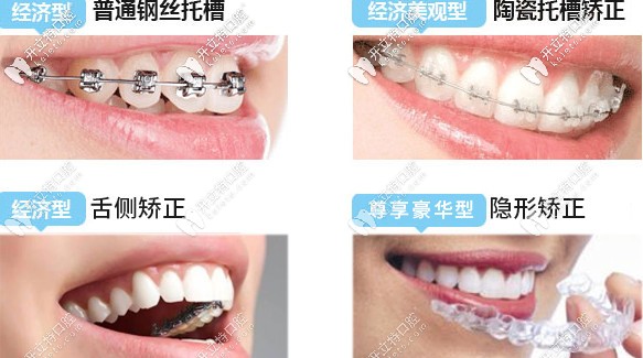 常德美奥口腔医院箍牙价格是多少这些牙套该怎样选呢