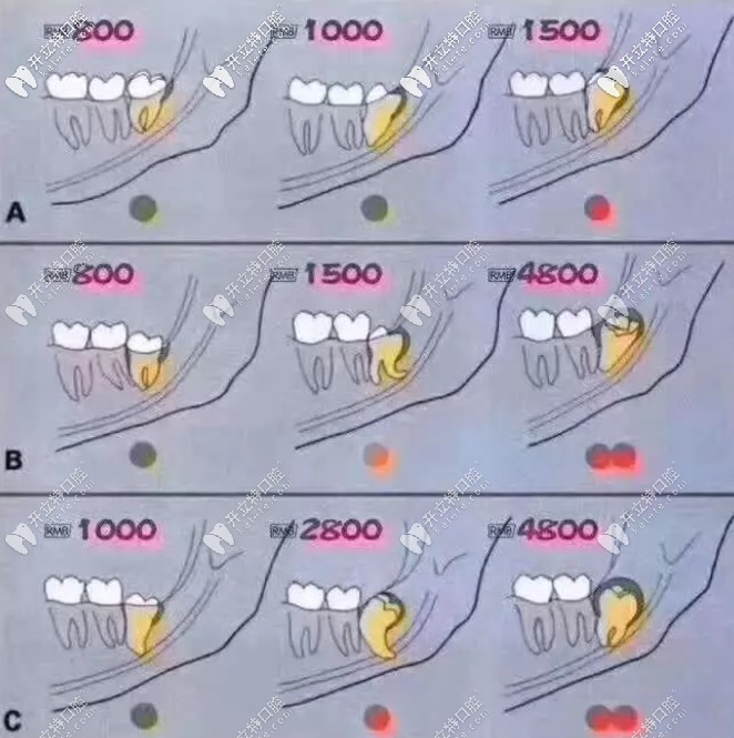 根据牙齿长势判断拔智齿的收费依据,瞧你是多少钱的智齿