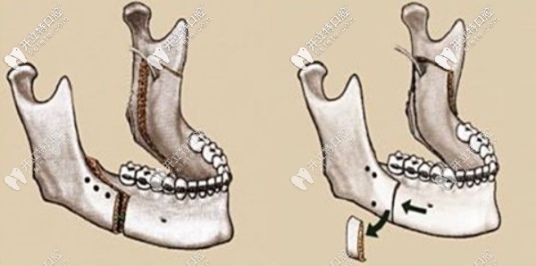 那就是正颌手术,一般难度比较大的骨性牙齿不齐需要做正颌 价格一般