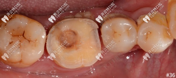 36,46高嵌体修复  治疗过程: 1,36牙体预备:全覆盖式高嵌体洞型预备