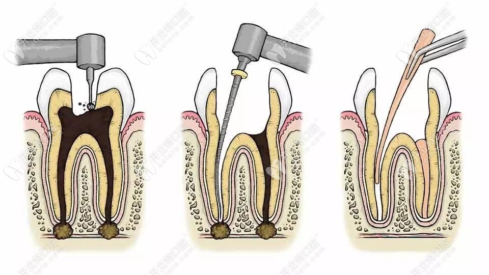 牙医解答:牙根纵裂的形成原因和治疗方法都在这了