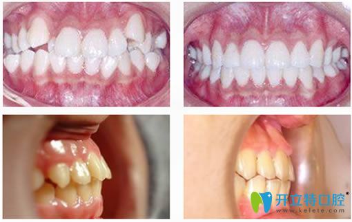 南京雅康口腔牙齿矫正案例