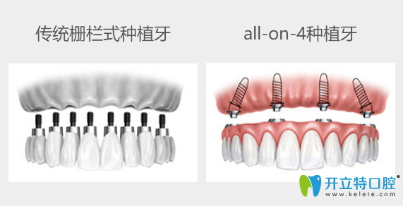 传统种牙与all-on-4种植牙技术对比