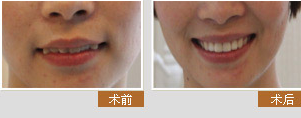 宁波牙博士高永峰医生仿生美牙冠矫正前后对比图展示