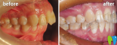 厦门登特口腔南祥明口腔正畸案例效果图