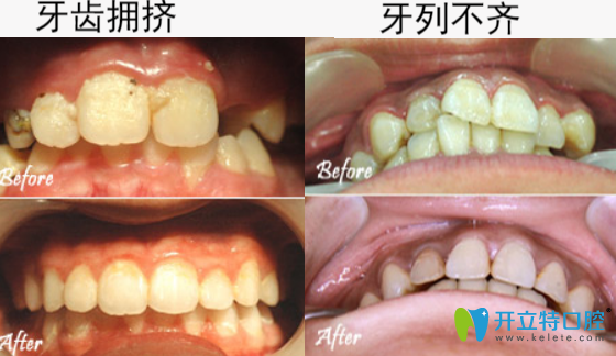 惠州致美口腔高自立牙齿正畸矫正案例