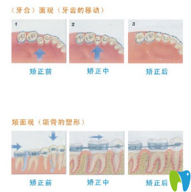 牙齿矫正过程