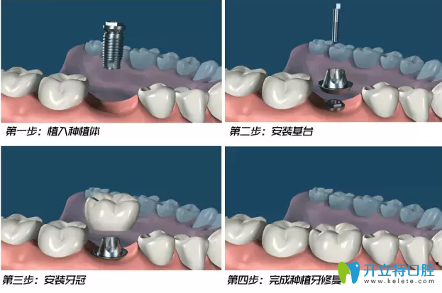 郴州植贝尔口腔种植牙过程