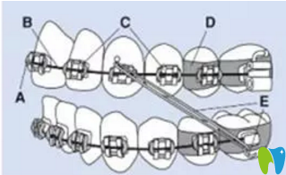 徐州博爱口腔牙齿矫正示意图