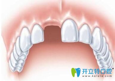 门牙缺失的赵先生在玉溪舒尔口腔做种植牙修复成功