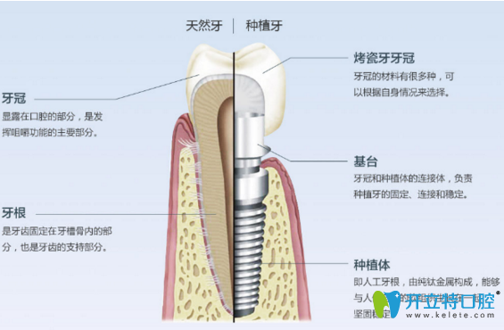 郴州植贝尔口腔医生解析：种植牙会不会很疼？