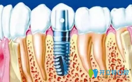 牙齿种植介绍