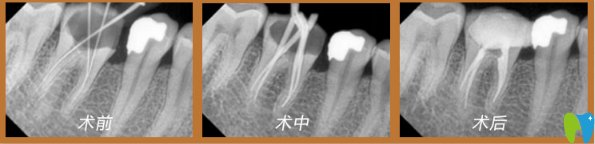 牙齿蛀虫治疗过程