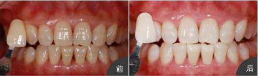 长沙半岛口腔长沙半岛口腔杨俊为我做的牙齿美白，让牙齿轻松变白