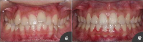 长沙半岛口腔长沙半岛口腔张琼为我做的牙齿矫正，一年后牙齿就变整齐
