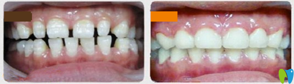 牙列稀疏前后对比