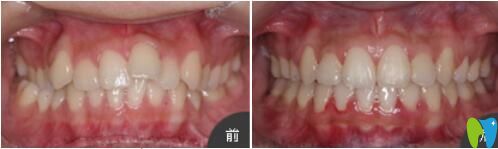<!--<i data=20240703-sp></i>-->口腔张琼牙齿矫正真人案例效果对比