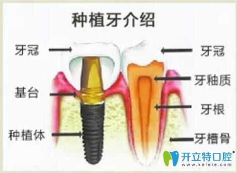 种植牙图解