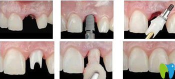 北京京一口腔种植牙步骤图